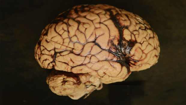 nfl-cte-brain.jpg