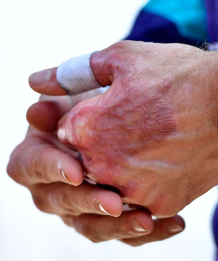 Grosjean underwent multiple surgeries on his left hand to ease the pain caused by his time spent inside the fire.