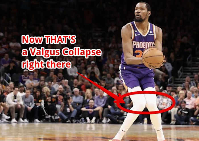 kd valgus collapse